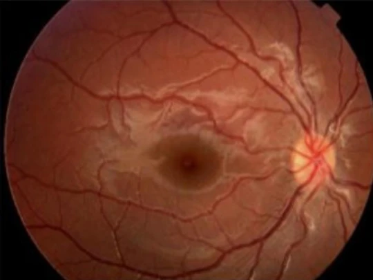 Medicina Oftalmologia Exame de Fundoscopia